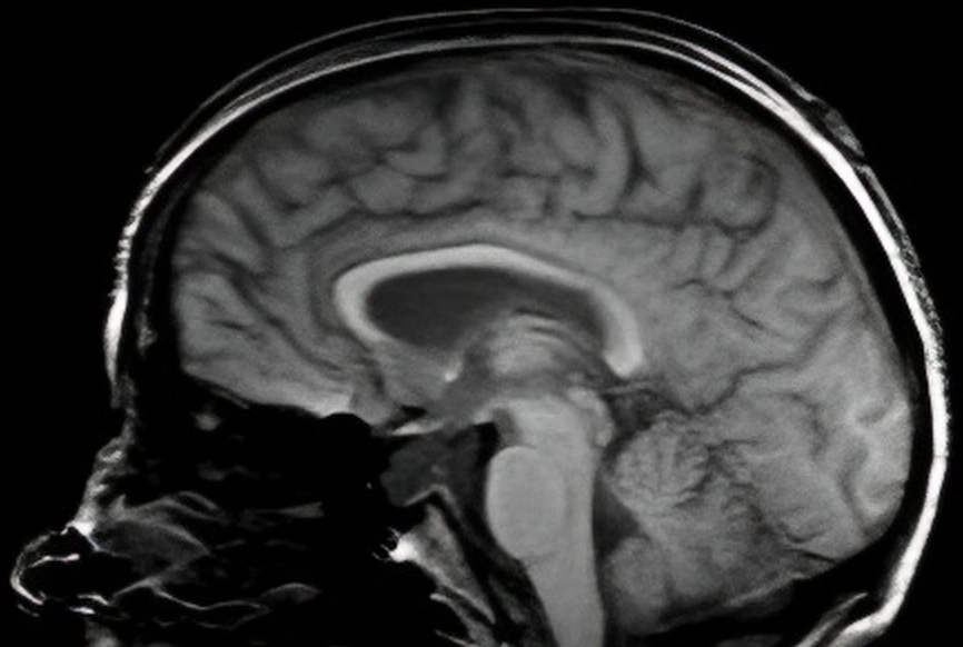Subarachnoid hemorrhage scan