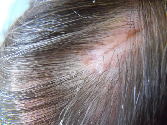 Head Scar From Surgery