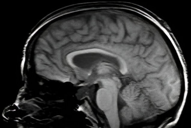 Subarachnoid hemorrhage scan